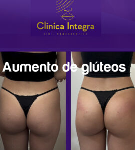 Aumento de gluteos