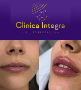 Relleno de Labios